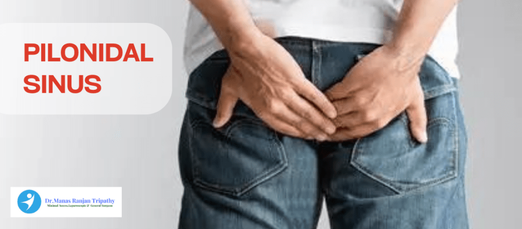 Surgery for Pilonidal Sinus | Pilonidal Sinus Treatment in HSR Layout by Dr. Manas Tripathy